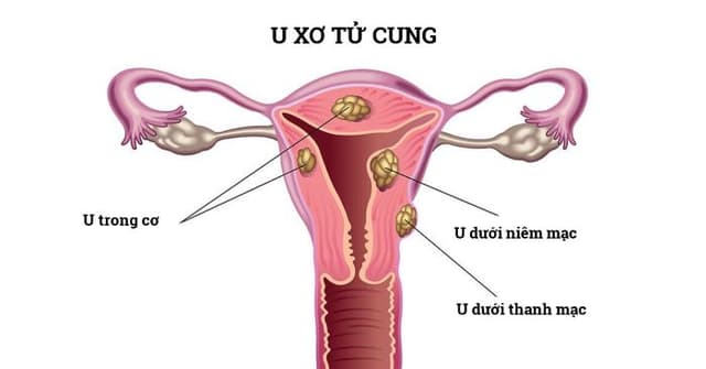 U xơ tử cung tuổi mãn kinh có cần điều trị không?