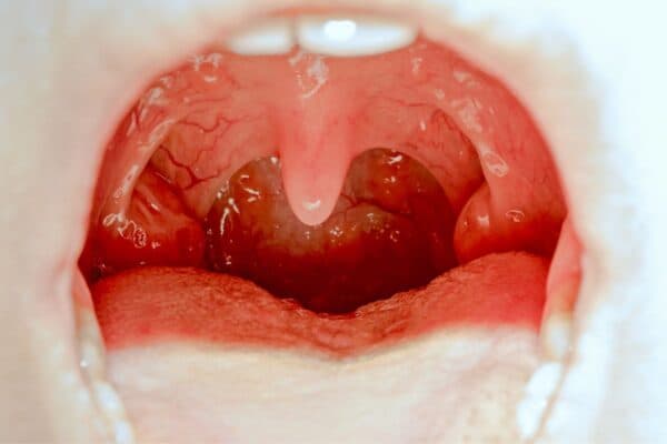 Viêm amidan là tình trạng viêm nhiễm tổ chức lympho ở cổ họng