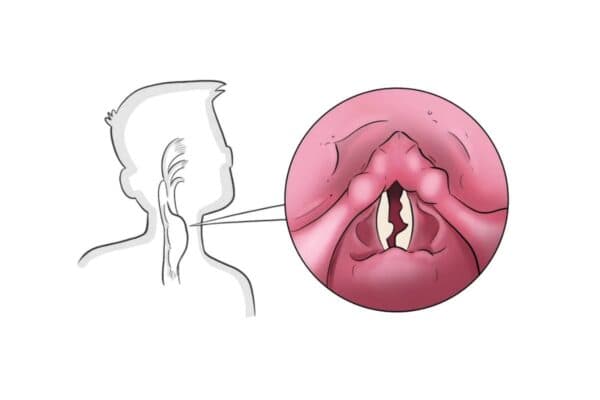 Viêm thanh quản là bệnh đường hô hấp nguy hiểm