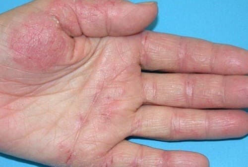 Viêm da cơ địa cần được phát hiện đúng và điều trị đúng cách