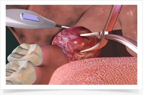 Việc cắt amidan là điều cần thiết để tránh các biến chứng nguy hiểm có thể xảy ra. 