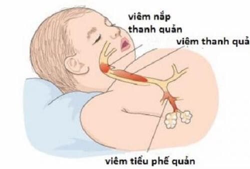 Nguyên nhân gây viêm tiểu phế quản ở trẻ