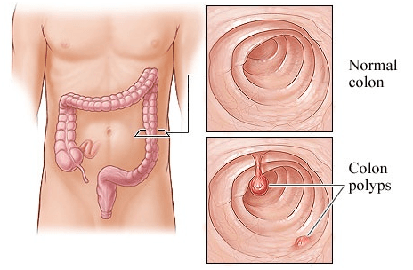 Polyp đại tràng cần được xử trí đúng cách