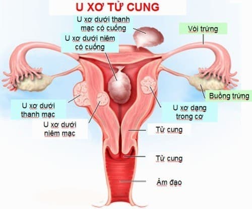 U xơ tử cung cần được phát hiện sớm và điều trị đúng cách