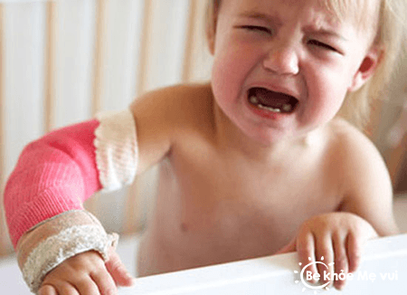 Xử trí thế nào khi trẻ bị gãy xương