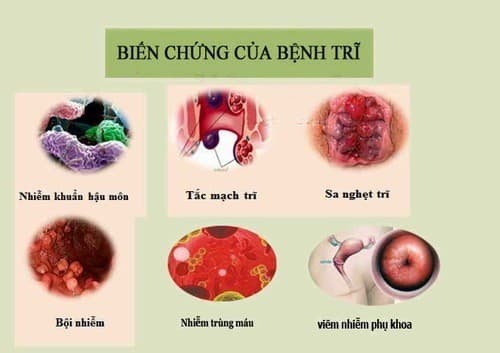 Biến chứng nguy hiểm của bệnh trĩ