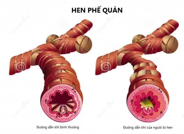 Theo thống kê, 5-10% trẻ bị mắc hen phế quản và 2-3% người bị tử vong do viêm phế quản.