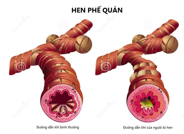 Các mức độ bệnh của hen phế quản