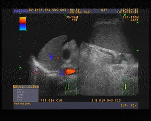 Trước khi điều trị, dịch cổ trướng của bệnh nhân N.V.T xuất hiện nhiều trong ổ bụng