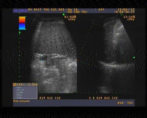 Sau 1 tháng điều trị, dịch trong ổ bụng của ông T. đã hết hoàn toàn