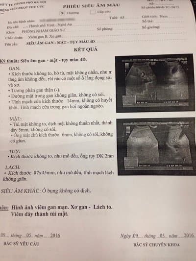 Ông V.Đ.P (Nghệ An) chỉ sau 4 lần điều trị, dịch cổ trướng đã hết hoàn toàn
