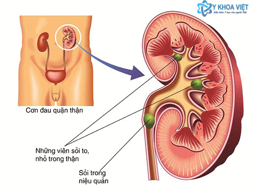 Sỏi niệu quản làm sao để loại bỏ?