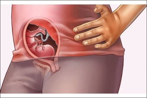 Suy thai có thể diễn biến từ từ trong quá trình mang thai hoặc xảy ra vào thời điểm chuyển dạ