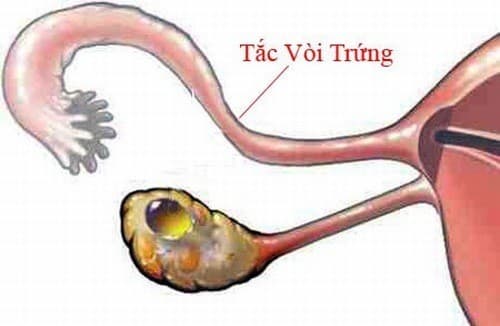 Tắc vòi trứng có mang thai được không phụ thuộc vào mức độ nghiêm trọng của bệnh và hiệu quả sau điều trị