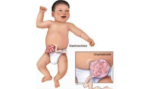 Thoát vị bẹn thường gặp ở trẻ nhỏ 
