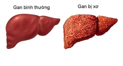 Viêm gan B nếu không được điều trị kịp thời có thể dẫn đến xơ gan