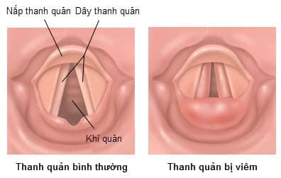 Viêm thanh quản là bệnh lý thường gặp cần được phát hiện sớm và điều trị đúng cách