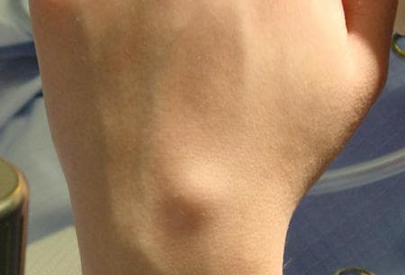 Triệu chứng của u bao hoạt dịch