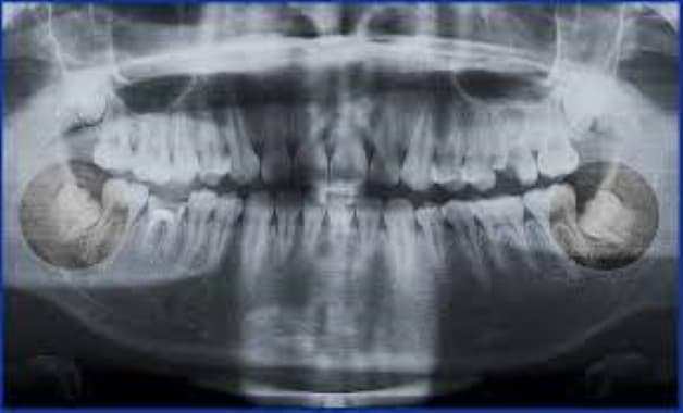 xử lý răng khôn