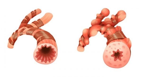 viêm phế quản co thắt ở trẻ