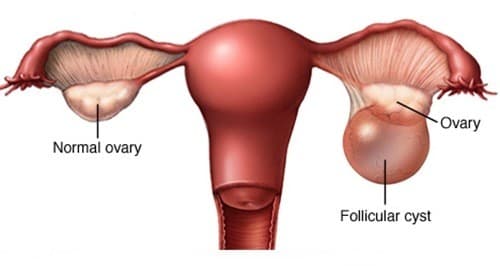 U nang buồng trứng cần được phát hiện và điều trị đúng cách