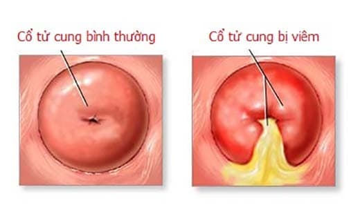 hình ảnh cổ tử cung bị viêm