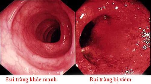 Bệnh Crohn đại tràng có xu hướng dễ xảy ra giữa những người thân trong gia đình, họ hàng.