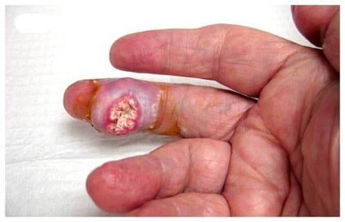 Biến chứng viêm khớp do bệnh gout