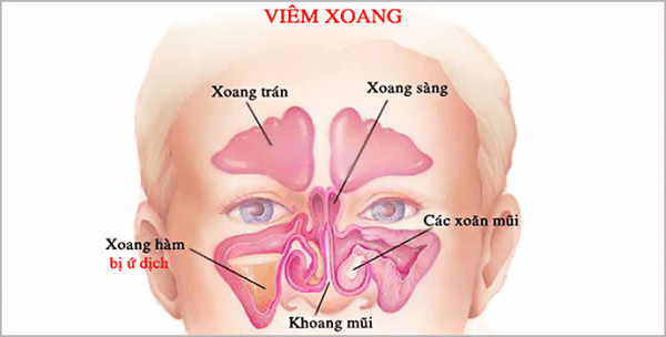 Dựa vào vị trí viêm xoang mà 