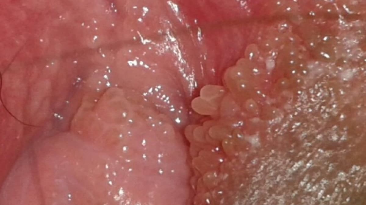 Gai sinh dục là sự phát triển mất kiểm soát của tế bào vùng thượng bì