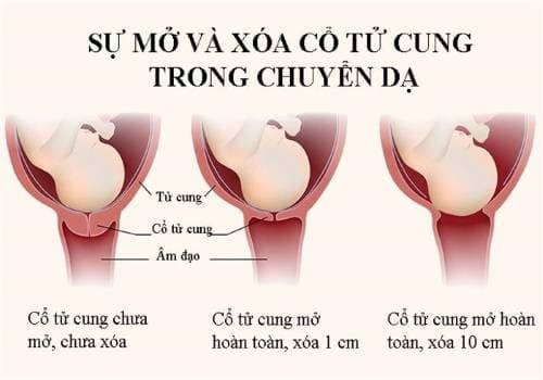 Độ xóa cổ tử cung khi mẹ bầu chuyển dạ