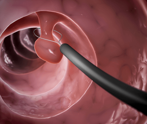 Khi nào nên mổ polyp lòng tử cung?