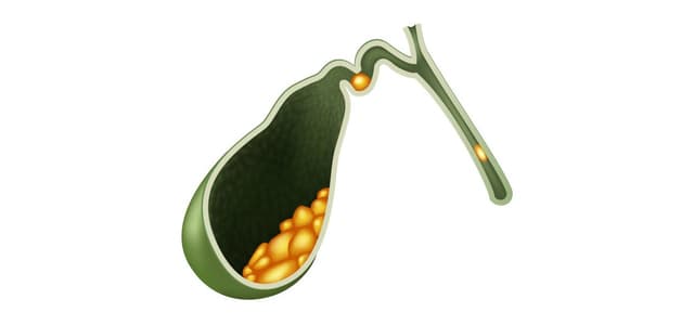 Những điều cần biết về nguy cơ mắc sỏi mật