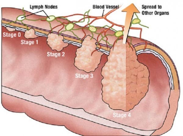 Polyp trực tràng có thể gây nên biến chứng nguy hiểm cần được phát hiện sớm và 