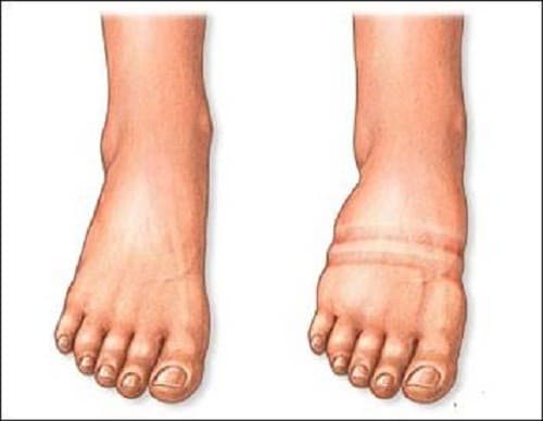 Thận bị hỏng không loại bỏ được chất lỏng dư thừa, vì thế chất lỏng tích tụ trong cơ thể khiến bạn bị phù 