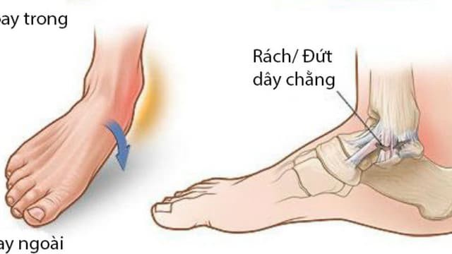 Cách làm giảm sưng ở chân và mắt cá chân