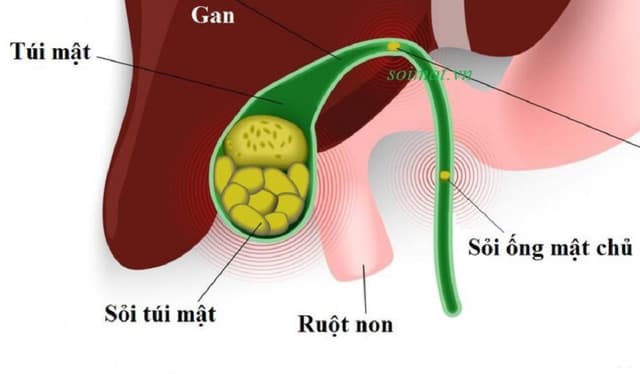 Các bệnh về túi mật thường gặp