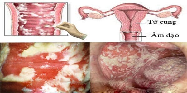 Hình ảnh bệnh viêm âm đạo