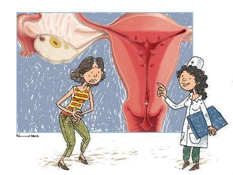 tim-hieu-ve-polyp-noi-mac-tu-cung