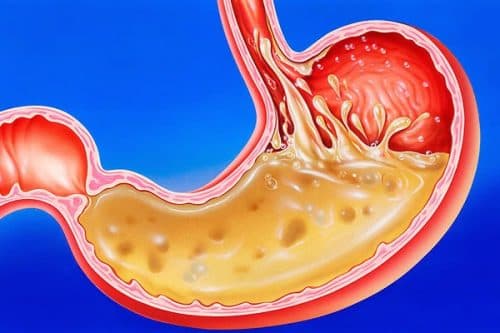 Ợ nóng là dấu hiệu điển hình của bệnh trào ngược dạ dày thực quản ở người lớn. 