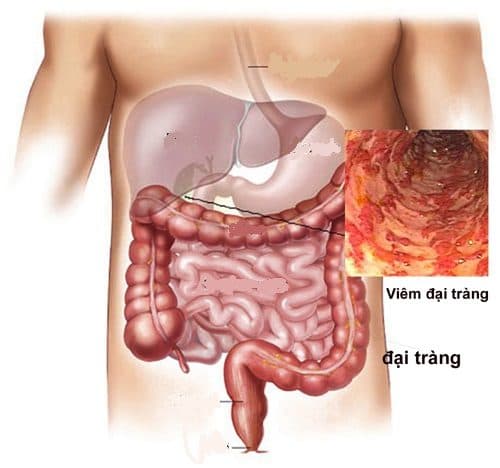Câu hỏi bệnh đường ruột là gì đến từ rất nhiều người bởi các bệnh thuộc nhóm này vô cùng phổ biến hiện nay.