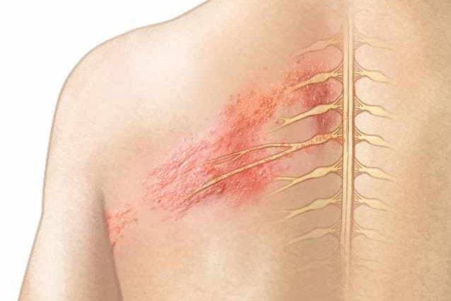 Triệu chứng Zona thần kinh bạn cần biết
