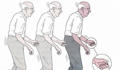 Bệnh Parkinson gây ra những triệu chứng như run tay chân, đi lại không vững