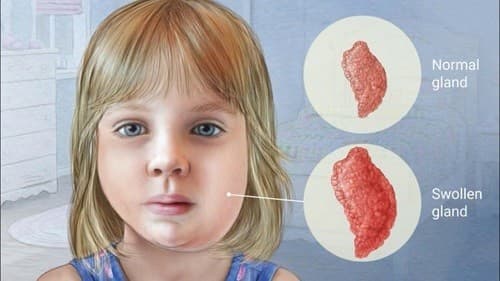 biểu hiện bệnh quai bị