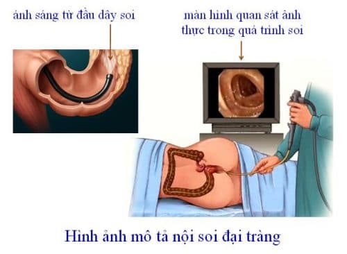 Nội soi đại tràng có đau không