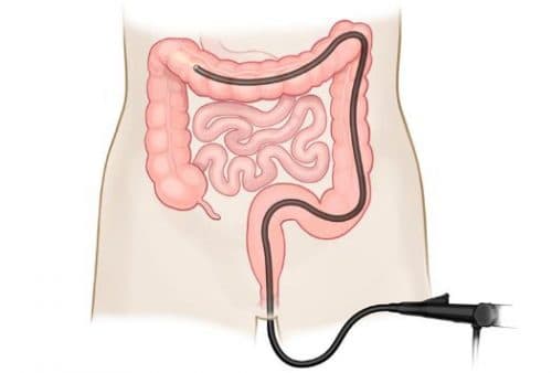 Nội soi đại tràng có đau không là quan tâm của rất nhiều người đặc biệt là những người đang có ý định đi nội soi đại tràng.