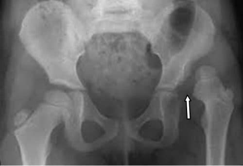 Trật khớp háng: Dấu Hiệu nhận viết và Phương pháp Điều trị 1