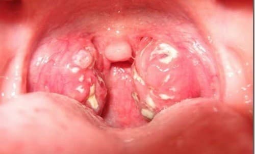 Từ A đến Z bệnh viêm họng hạt là gì?