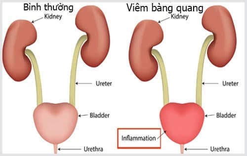 Viêm bàng quang cần được phát hiện sớm và điều trị hiệu quả