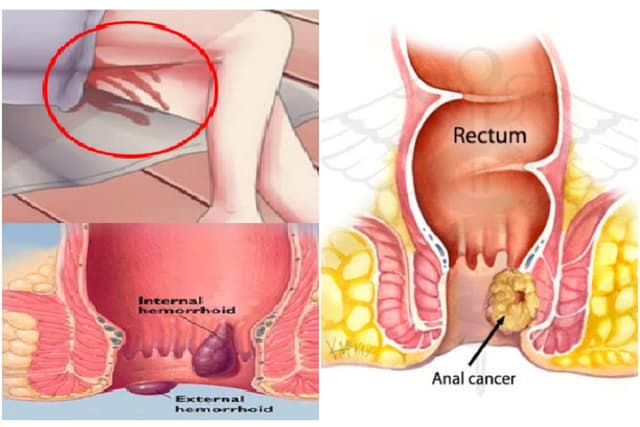 Hình ảnh ung thư hậu môn biến chứng nguy hiểm